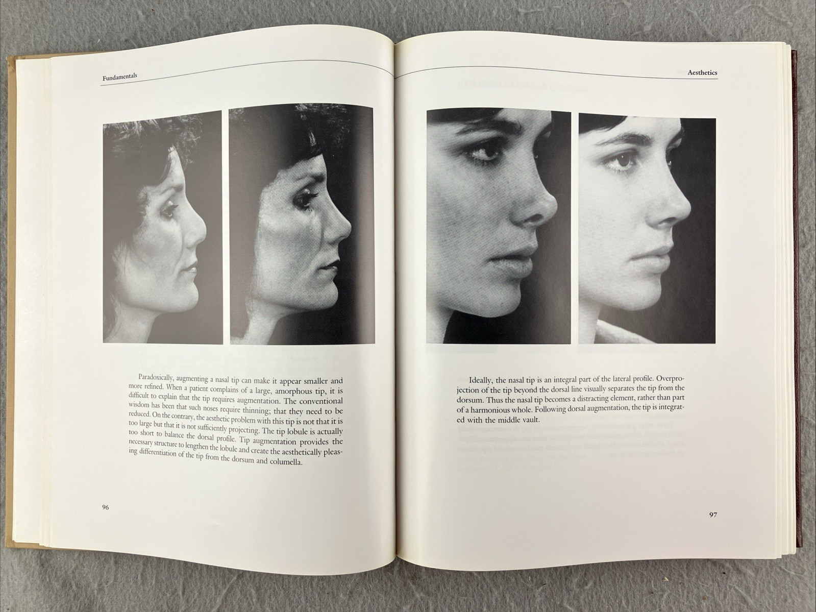Aesthetic Rhinoplasty 2 volume set, Jack Sheen and A.Peebles, Plastic Surgery