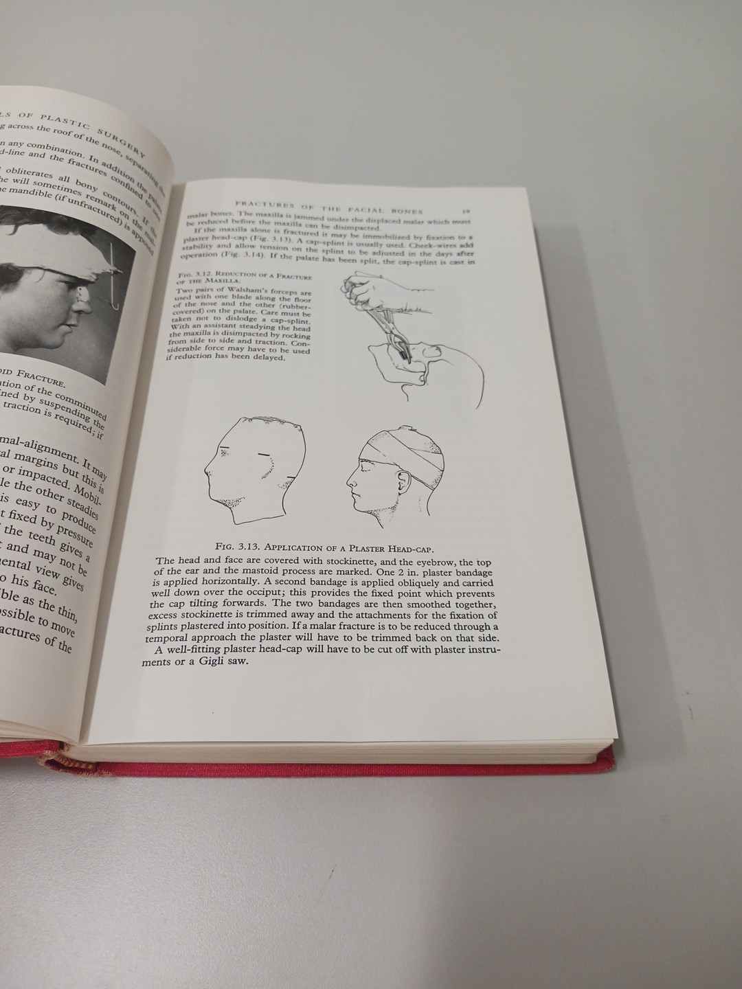 Essentials Of Plastic Surgery Peet And Patterson 1st Edition 1963