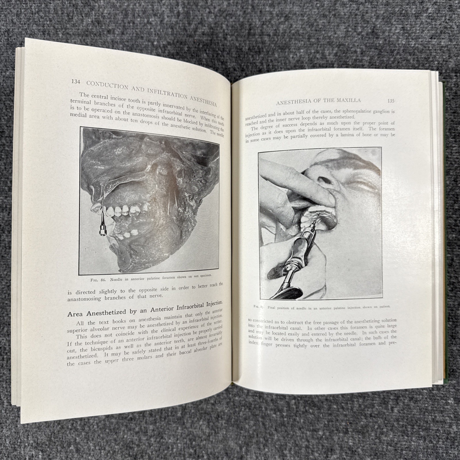 Conduction Infiltration General Anesthesia Dentistry 1943 4th Nevin & Puterbaugh